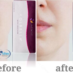 Juvederm Volbella Injection 4